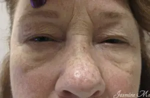 Ptosis Repair Before and After Pictures Tampa Bay, FL