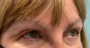 Ptosis Repair Before and After Pictures Tampa Bay, FL
