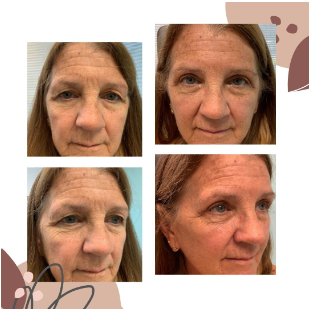 Eyelid Surgeons of Tampa Bay