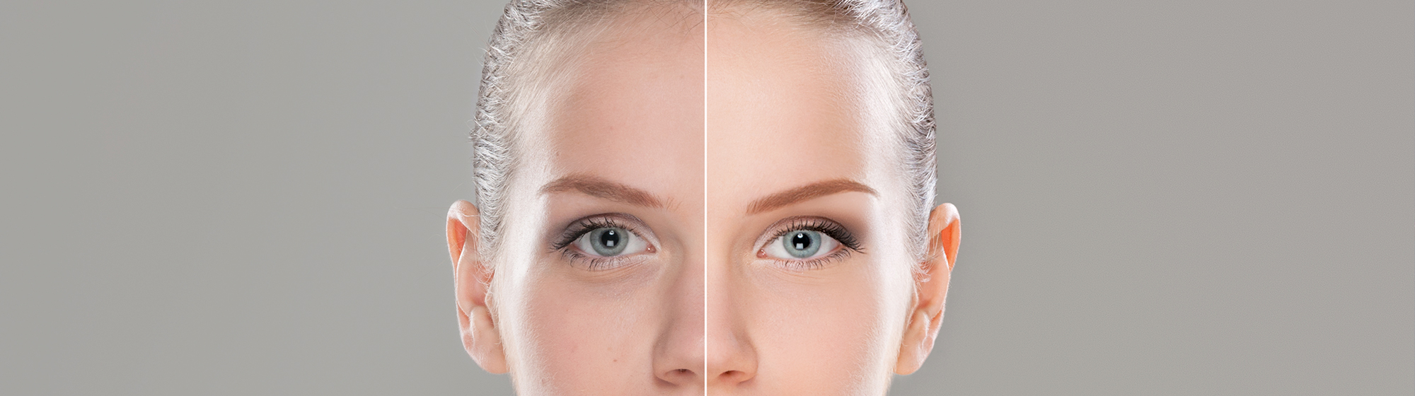 Laser Skin Resurfacing Before & After Photos in Tampa Bay, FL