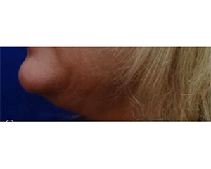 Dermal Filler and Injectables Before and After Pictures Tampa Bay, FL