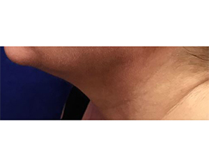 Dermal Filler and Injectables Before and After Pictures Tampa Bay, FL