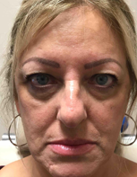Blepharoplasty Before and After Pictures Tampa Bay, FL