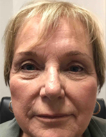 Blepharoplasty Before and After Pictures Tampa Bay, FL