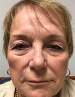 Blepharoplasty Before & After Photos in Tampa Bay, FL