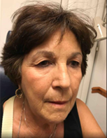 Blepharoplasty Before and After Pictures Tampa Bay, FL