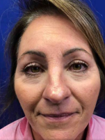 Dermal Filler and Injectables Before and After Pictures Tampa Bay, FL