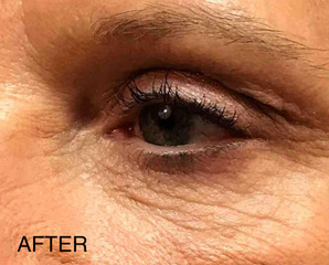 Dermal Filler and Injectables Before and After Pictures Tampa Bay, FL