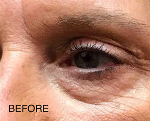 Dermal Filler and Injectables Before and After Pictures Tampa Bay, FL