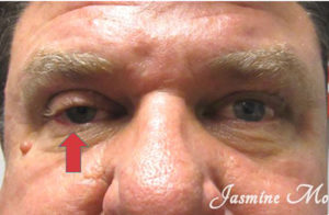 Ptosis Repair Before and After Pictures Tampa Bay, FL