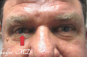 Ptosis Repair Before and After Pictures Tampa Bay, FL