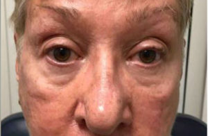 Ptosis Repair Before and After Pictures Tampa Bay, FL