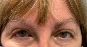 Ptosis Repair Before and After Pictures Tampa Bay, FL