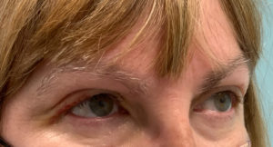 Ptosis Repair Before and After Pictures Tampa Bay, FL