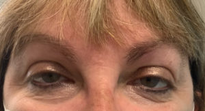 Ptosis Repair Before and After Pictures Tampa Bay, FL