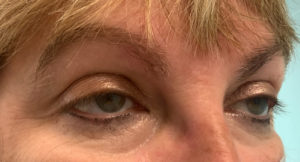 Ptosis Repair Before and After Pictures Tampa Bay, FL