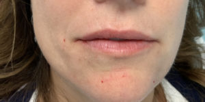 Dermal Fillers and Injectables Before and After Pictures Tampa Bay, FL