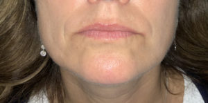 Dermal Fillers and Injectables Before and After Pictures Tampa Bay, FL