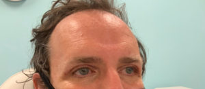 Blepharoplasty Before and After Pictures Tampa Bay, FL