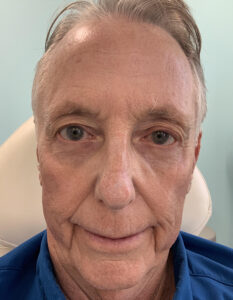 Blepharoplasty Before and After Pictures Tampa Bay, FL